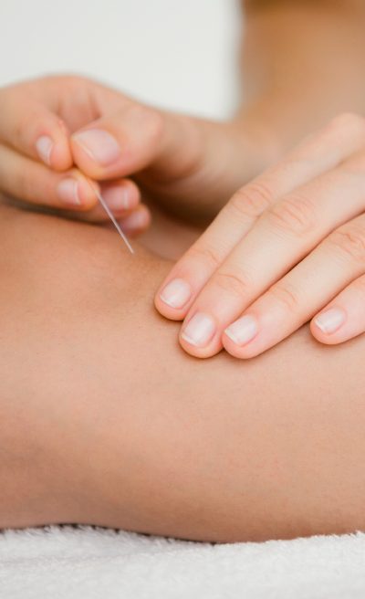 Acupuncture Dry Needling Improve Restore Function